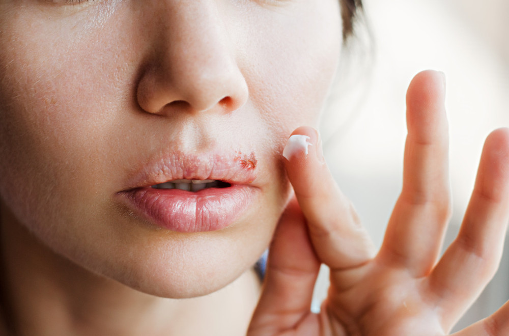 Herpes na usni: Sve što bi trebalo da znate
