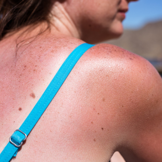 Znakovi raka kože mogu se razviti nakon samo 15 minuta provedenih na suncu