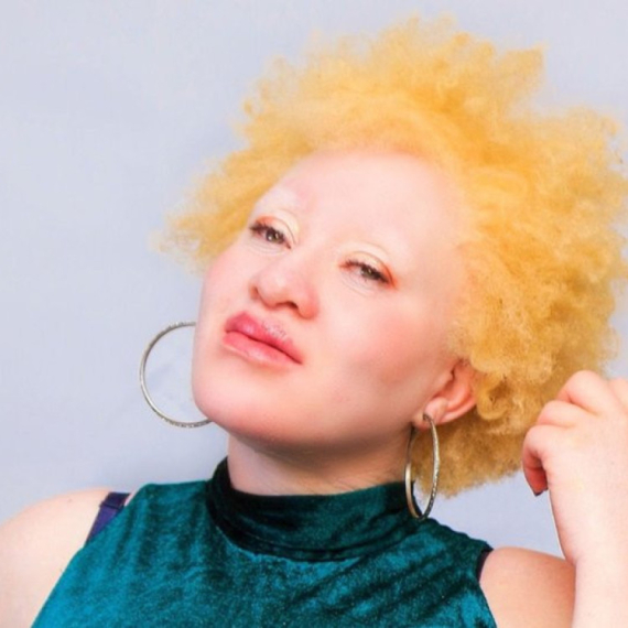 "Moj silovatelj je verovao da će ga napad na albino osobu zaštititi od bolesti"