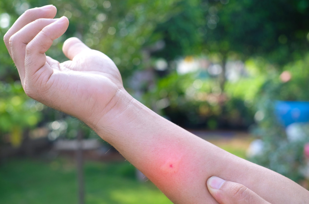 Povećan broj uboda insekata: Izazivaju alergijske reakcije na koži