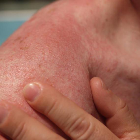 Alergija na sunce je sve češća kod ljudi: Koji su simptomi i kako je lečiti VIDEO